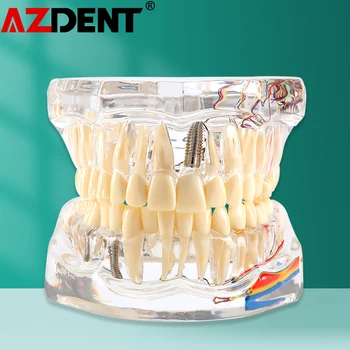 Зъбни импланти, патологична модел на зъбите, обучение модел на зъба студенти-зъболекар